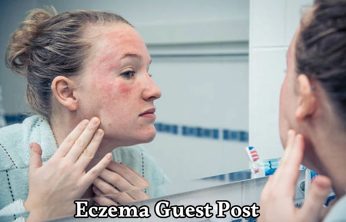 Eczema Guest Post