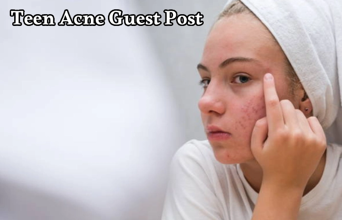 Teen Acne Guest Post