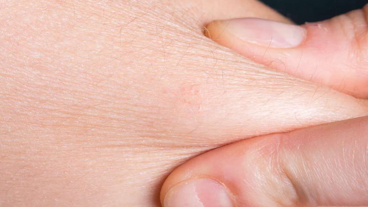 How To Get Rid Of Dry Skin In Winter