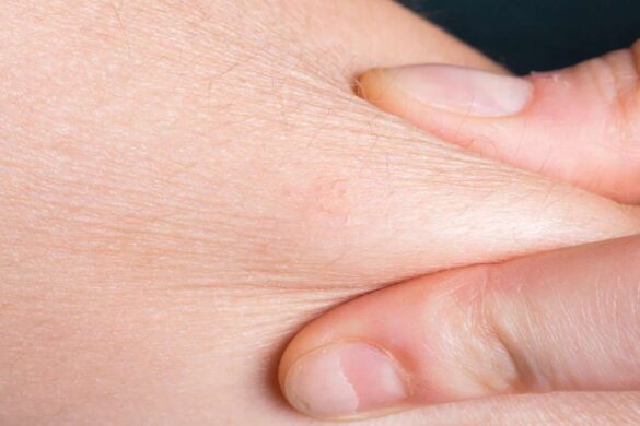 How To Get Rid Of Dry Skin In Winter