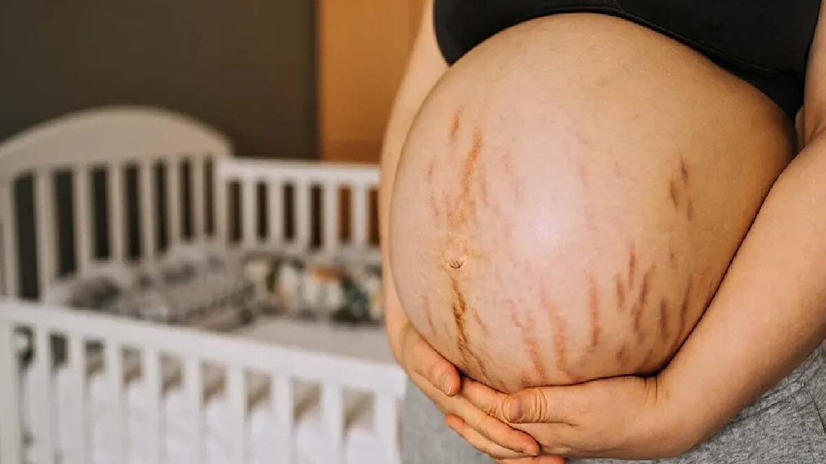 Prevention Of Stretch Marks Resulting from Pregnancy