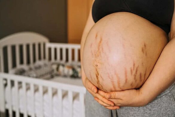 Prevention Of Stretch Marks Resulting from Pregnancy