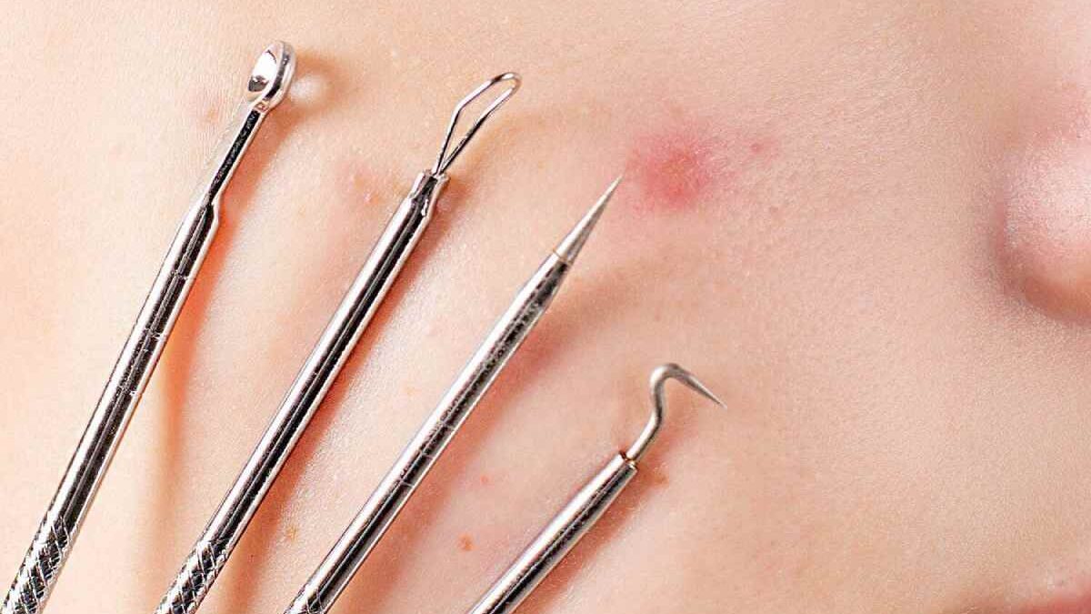 How To Remove the Blackheads – Recipes and Various Ways