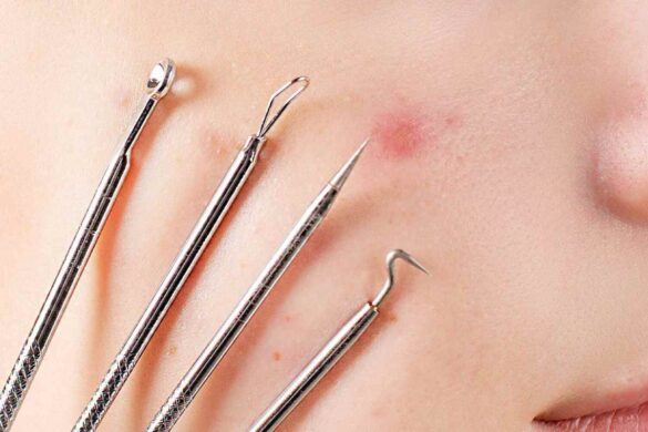 Remove the Blackheads