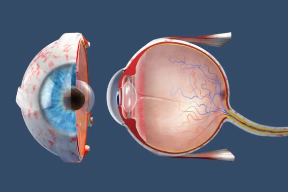 Why do scientists fear an increase in myopia?